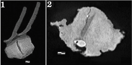 CT scans reveal the embedded tooth.